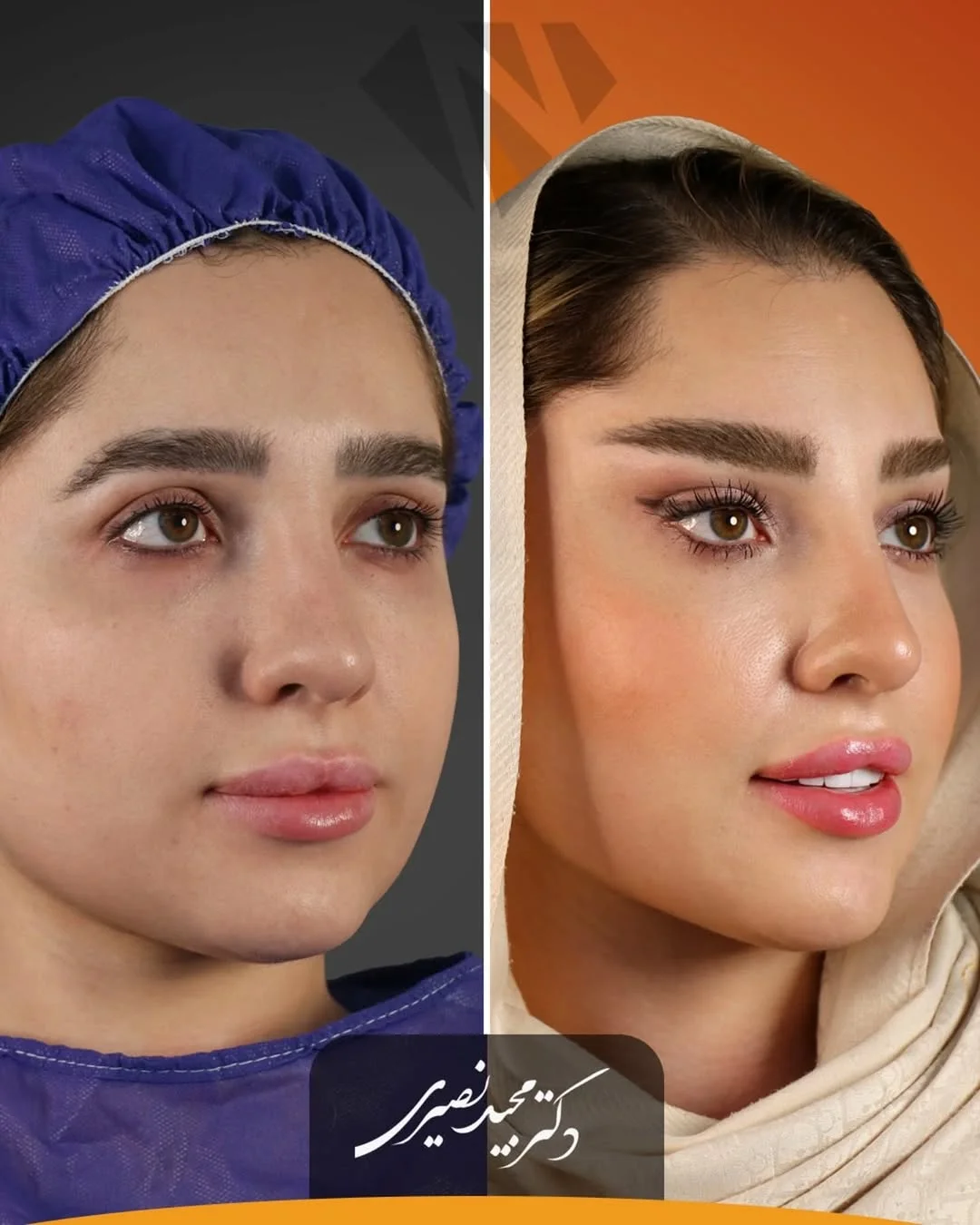 لیفت شقیقه با اندوتاین